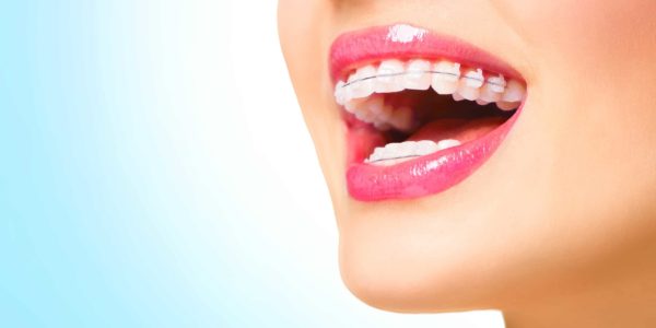 ceramic-braces-barrhaven-ottawa ceramic-braces-barrhaven-ottawa